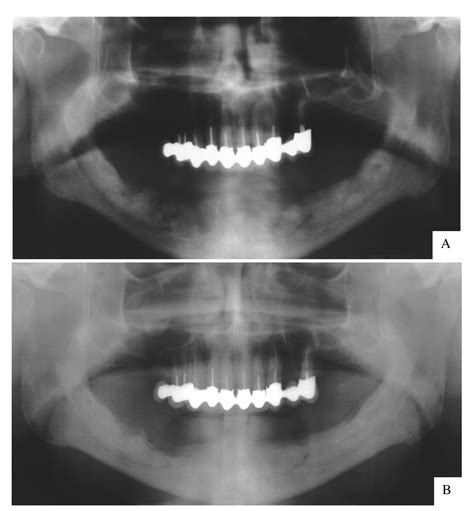 Regeneration Of Mandibular Osteoradionecrosis Defect With Platelet Rich