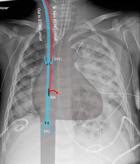 Pediatric Extracorporeal Membrane Oxygenation Ecmo A Guide For