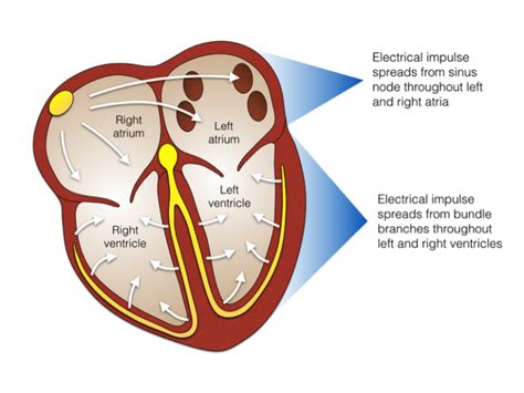 Atrial Flutter Ablation Patient Information Heart Rhythm Clinic