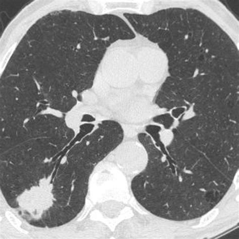 Ct Image Taken At The Lower Lobes Level Showing A Right Lower Lobe Lung Download Scientific