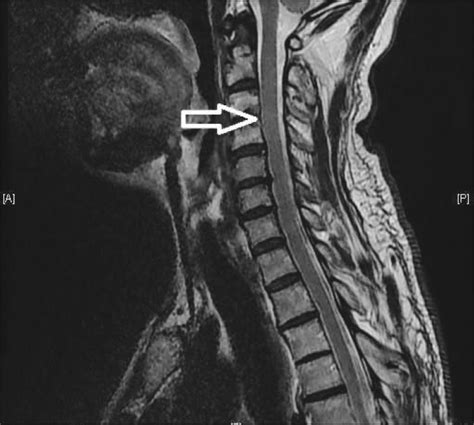 Surgical Management Of Cervical Spinal Epidural Abscess Caused By