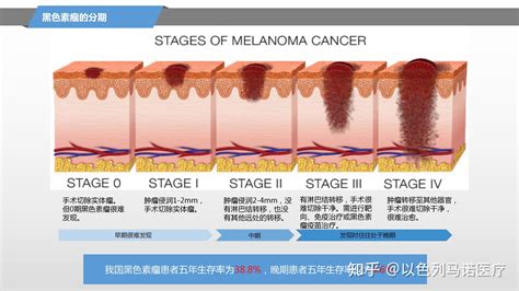 黑色素瘤的早期发现及预防愈后复发的重要性 知乎