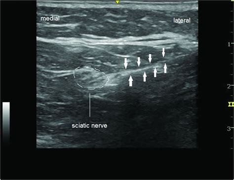 Ultrasound-guided sciatic nerve block | Anesthesia Key