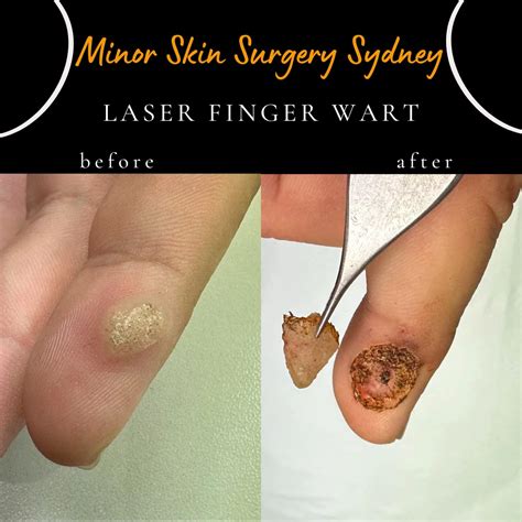 Laser Wart Removal & Treatment Sydney - Finger warts, Plantar warts ...