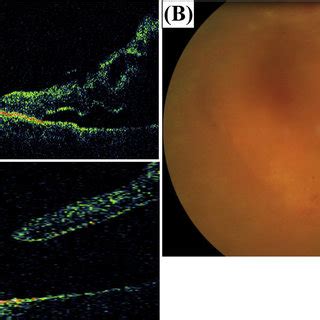 Case A Fundus Photography Shows That The Fvp Is Located Mainly On