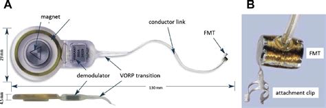 Vibrant Soundbridge Rehabilitation Of Sensorineural Hearing Loss Otolaryngologic Clinics Of