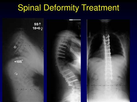 PPT - Spinal Deformity and Degeneration PowerPoint Presentation, free ...