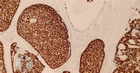 Endocrine Mucinproducing Sweat Gland Carcinoma Pathology Image