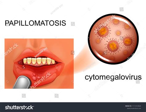 Vector Illustration Oral Mucosal Papillomatosis Cytomegalovirus Stock