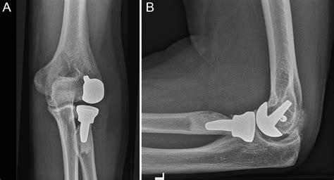 Radiocapitellar Prosthetic Arthroplasty Short Term To Midterm Results