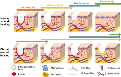 Comparison of healing process between chronic wound and normal wound ...