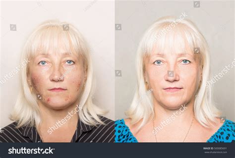 Womans Face Acne Before After Cosmetic Stock Photo 500085691 | Shutterstock