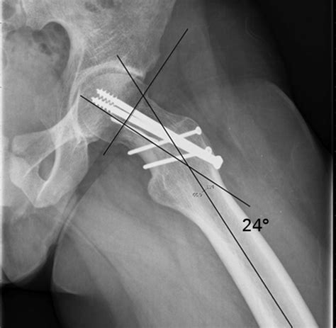 Subcapital Osteotomy Of The Femoral Neck For Patients With Healed