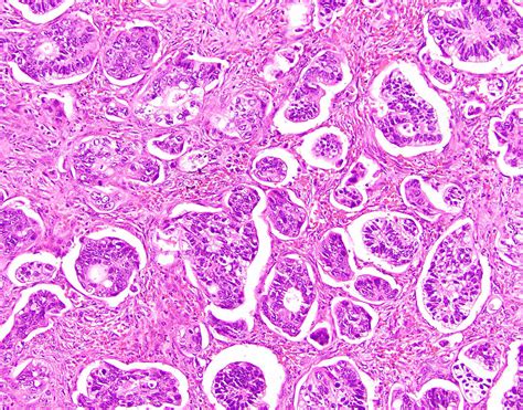 Adenocarcinoma Colon Histology