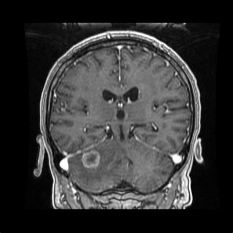 Filecerebellar Metastasis Of Pulmonary Adenocarcinoma Cavernous Venous Malformation And