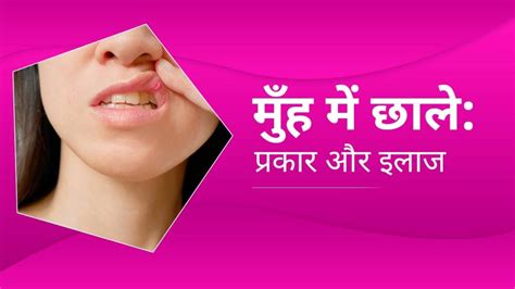 Mouth Ulcer Treatment Symptoms And Causes मुंह के छालो कि इलाज