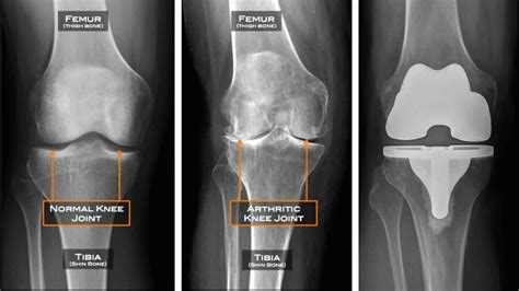 Anatomia Do Joelho Clínica Do Joelho