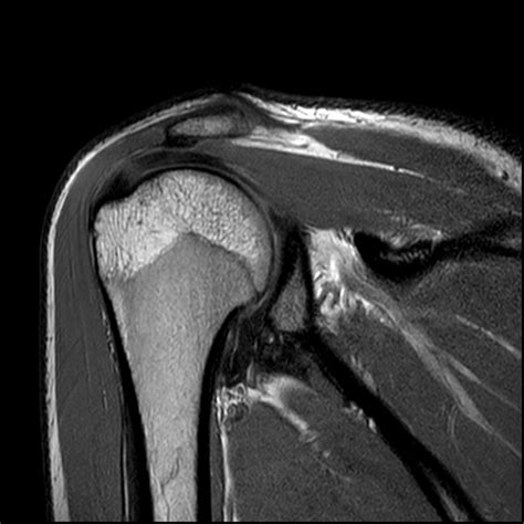 Ver a través de golondrina Rana shoulder joint mri anatomy Cortar Todos ...