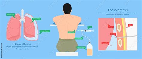 Vats Lung Cancer Treatment Sub Pus Tap Cell Open Tube Copd Rats Wedge Treat Tumor Lobar Blebs