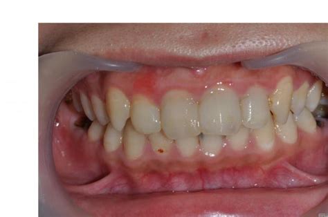 全瓷修复のsmile 赵春平 赵春平的博客 Kq88口腔博客