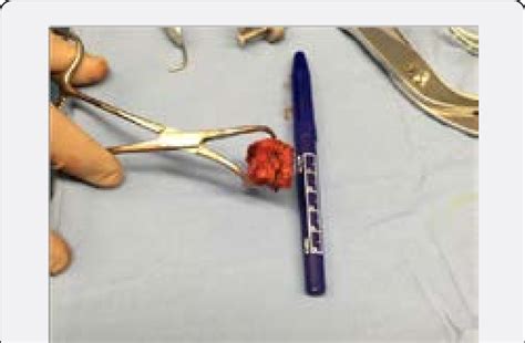 Tricortical Iliac Crest Bone Graft Yellow Arrow Showing The Osteotomy