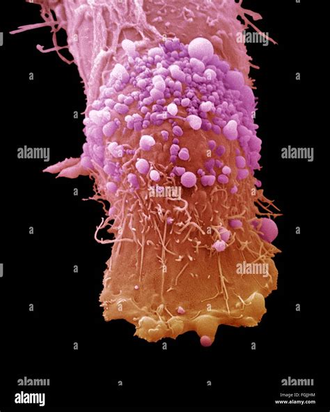 Skin Cancer Cell Coloured Scanning Electron Micrograph Sem Cultured