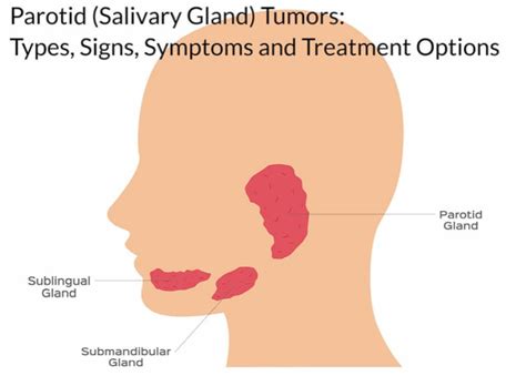 A Comprehensive Overview and Treatment Options of Salivary Gland Tumor - Techzle