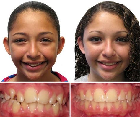 Adolescent braces | Dentist in Connecticut, Massachusetts, & New Hampshire