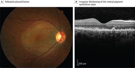 Acute And Painless Monocular Vision Loss In A Human Immunodeficiency