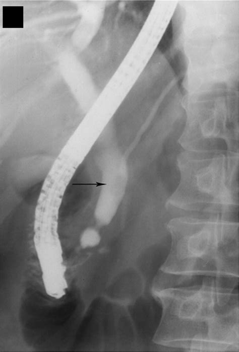 Mdct Cholangiography With Volume Rendering For The Assessment Of