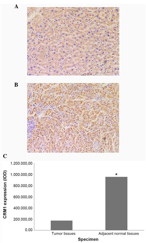 Chromosome Region Maintenance 1 Expression And Its Association With