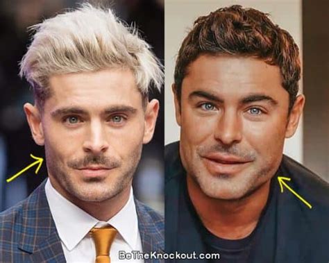 Zac Efron Plastic Surgery Comparison Photos