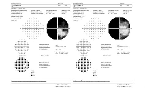 24 2 Humphrey Visual Field Test Ou Report September 2021 Download