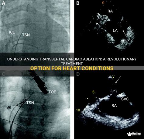 Understanding Transseptal Cardiac Ablation A Revolutionary Treatment