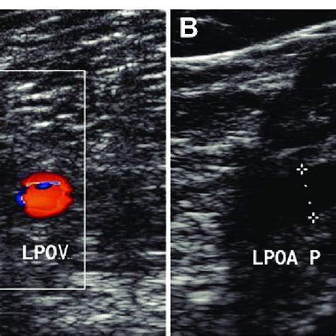 Left popliteal artery entrapment syndrome in 43-year-old man who... | Download Scientific Diagram