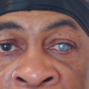 Prosthetic Eye Patient Photos | Carolina Eye Prosthetics