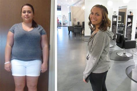 Weight Loss Surgery Success Story Molimart