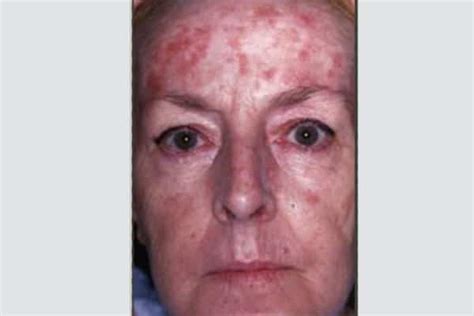 dr al rustom polyclinic sun damage