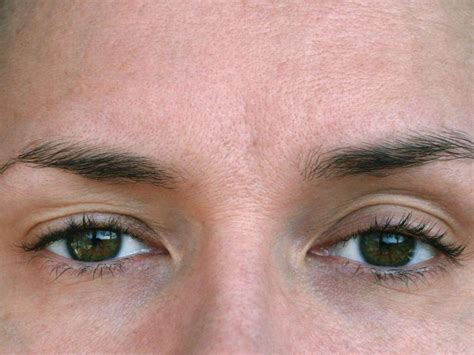 Palpebral Ptosis or Fallen Eyelids: What is the best solution?