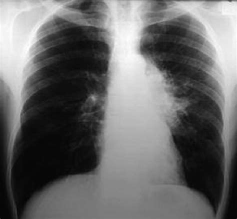 Chest X Ray Pulmonary Infiltrate In The Left Lung And Prominence Of Download Scientific