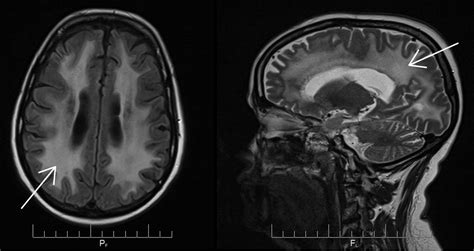 Prophylactic Cranial Irradiation 5 Years On Bmj Supportive