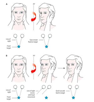 vertigo  hint   hints exam nuem blog