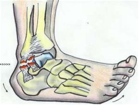 The 44 Best How To Treat Torn Ligaments In The Ankle How To