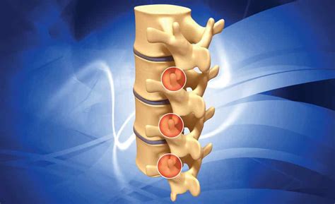 Lumbar Facet Joint Pain | Complete Physio