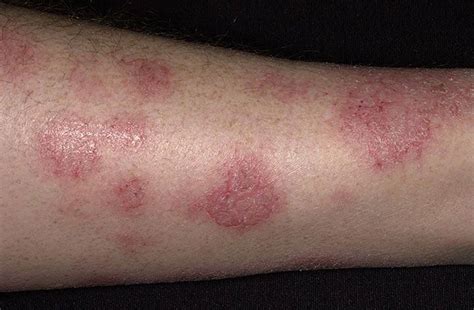 Nummular Eczema Pictures Treatment Causes Symptoms