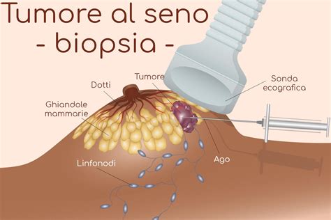 Tumore Al Seno Sintomi Prevenzione Cause Diagnosi