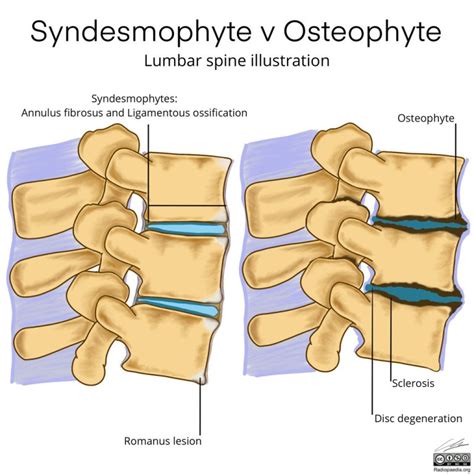 The elderly can do more exercise to prevent osteophytes – DeQsb