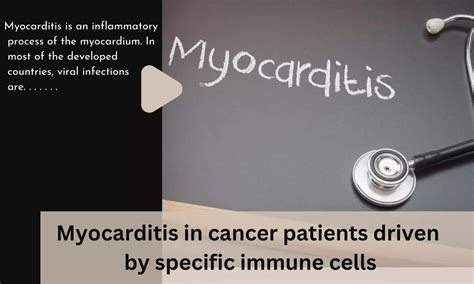 Myocarditis In Cancer Patients Is Driven By Specific Immune Cells