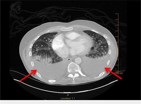 Bilateral Pleural Effusions Ct Scan Showing Bilateral Pleural Effusions