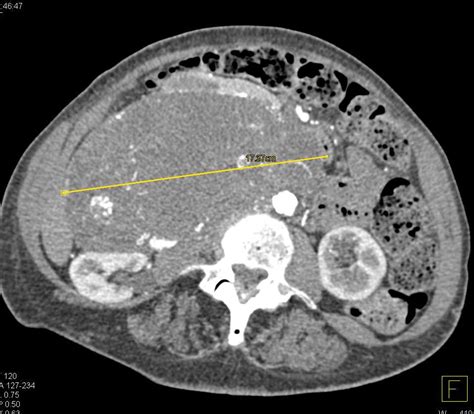 Retroperitoneal Liposarcoma Gastrointestinal Case Studies Ctisus Ct